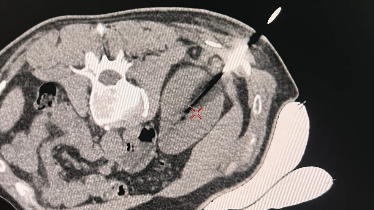 Lublin: Lekarze pomogli dwóm pacjentom z rakiem nerki. Zamiast operacji były małoinwazyjne zabiegi