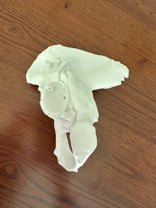 Pacjentka dostała protezę stawu z drukarki 3D. Wszczepili ją lekarze z Lublina