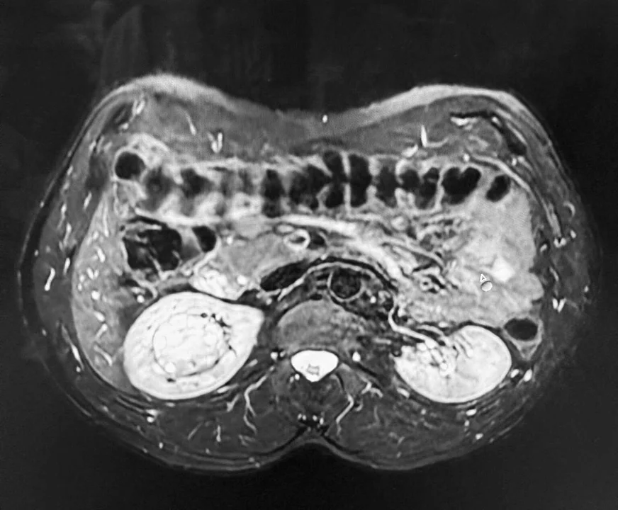 Lubelscy lekarze usunęli guz wielkości piłki tenisowej. Pan Marcin o chorobie dowiedział się przez przypadek