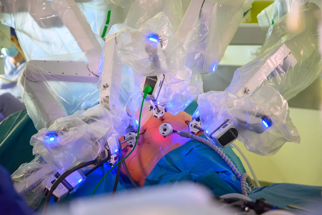 Precyzja robota, ekspresowy powrót do domu. W COZL da Vinci usunął olbrzymią śledzionę i guz