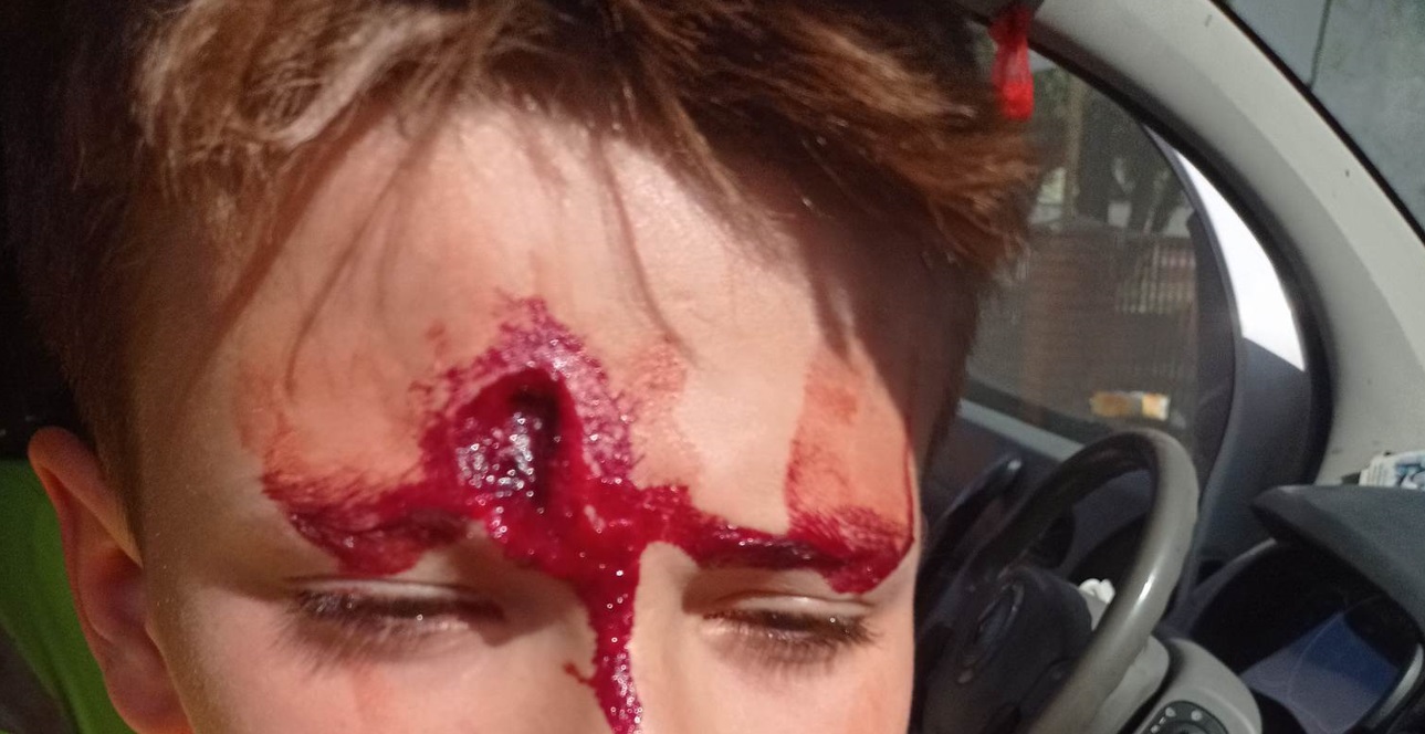 Przeszczep skóry nie przyjął się - mówi nam rodzina chłopca pobitego w Aleksandrowie - Zdjęcie główne