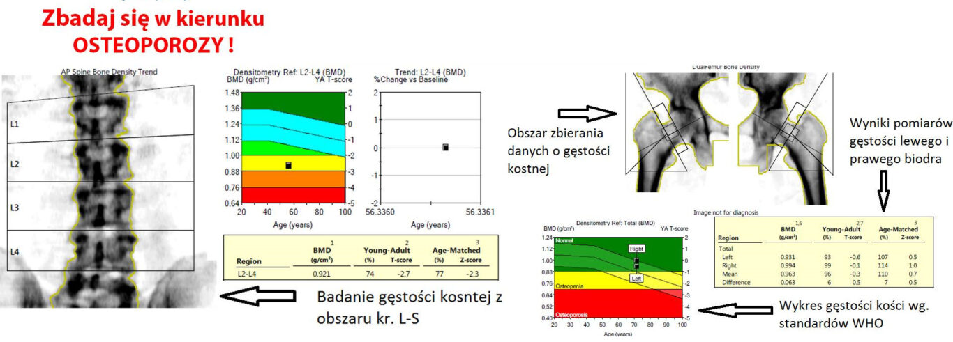 Badanie Osteoporozy - zbadaj swoje kości - Zdjęcie główne