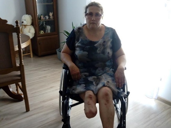 Proteza to jedyna szansa na życie dla Doroty - Zdjęcie główne