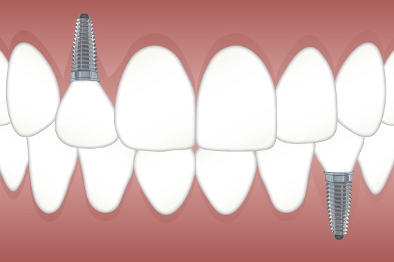 Implanty dentystyczne - innowacja w leczeniu jamy ustnej - Zdjęcie główne