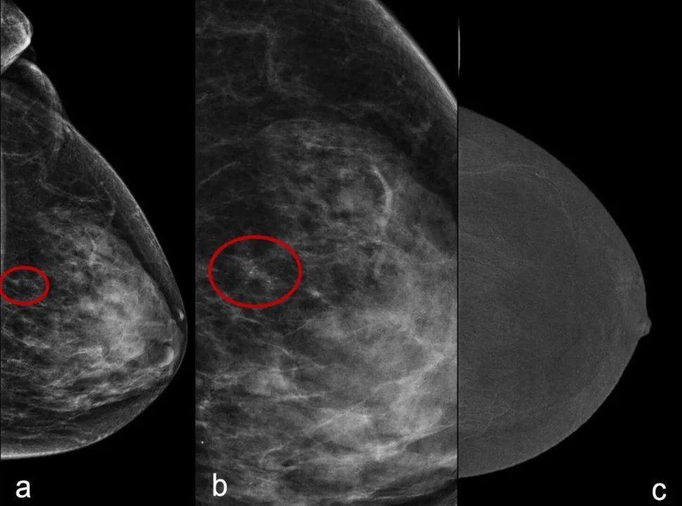 Ważne zmiany dla kobiet w zakresie mammografii i cytologii. Gdzie zbadać się w Łukowie stacjonarnie? Gdzie przyjadą mammobusy? - Zdjęcie główne