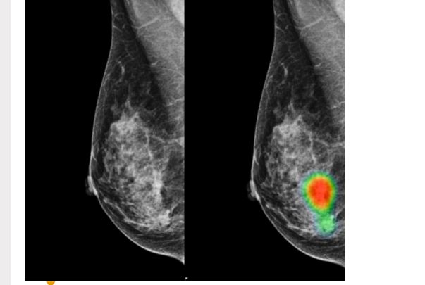 Mammografia w łukowskim szpitalu - Zdjęcie główne