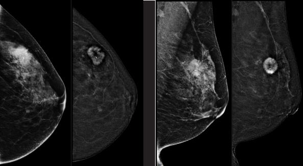 Zbadaj piersi. Zapisz się na mammografię w gminach - Zdjęcie główne
