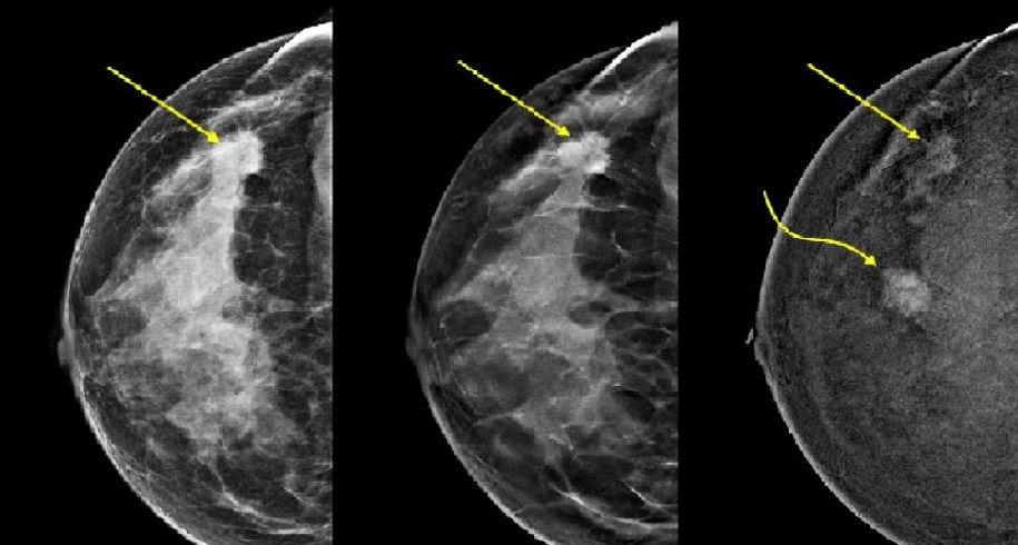 Kolejna akcja mammografii w Łukowie. Już w piątek 28 maja - Zdjęcie główne