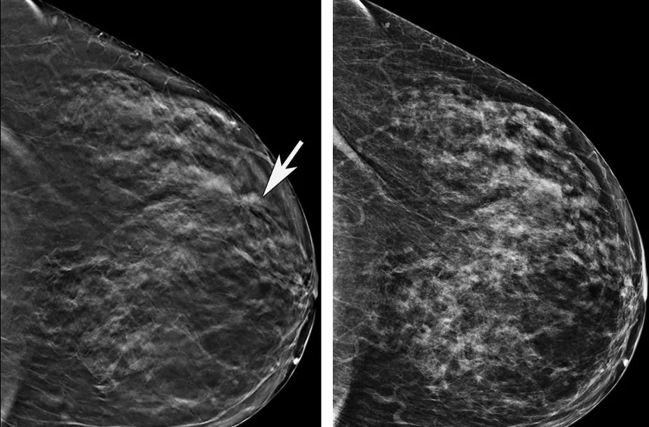 Bezpłatne badania mammograficzne  w łukowskim szpitalu od 45 r. życia. Rak wcześnie wykryty jest wyleczalny! - Zdjęcie główne